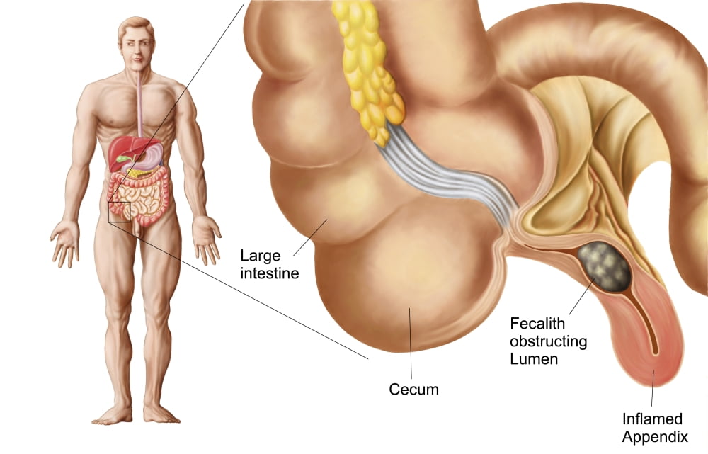 Medical ilustration of an appendix with appendicitis Canvas Art - Stocktrek Images (18 x 12)