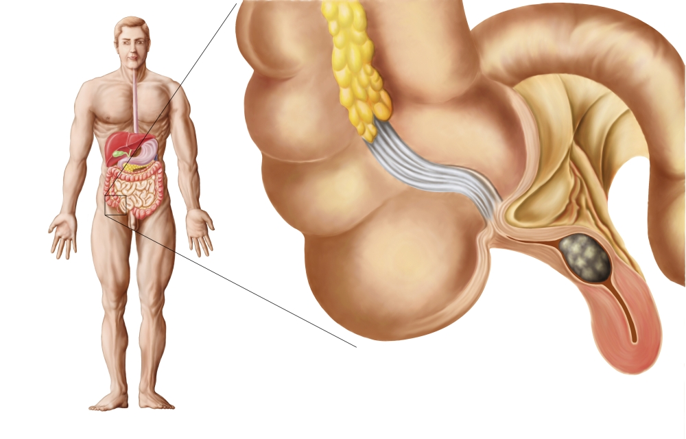 Medical ilustration of an appendix with appendicitis Canvas Art - Stocktrek Images (35 x 22)