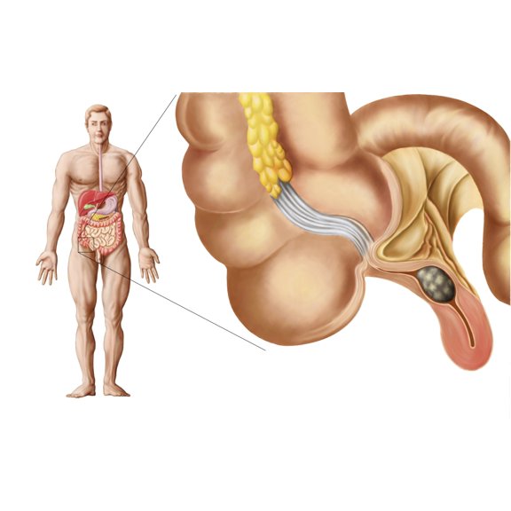 Medical ilustration of an appendix with appendicitis Canvas Art - Stocktrek Images (35 x 22)