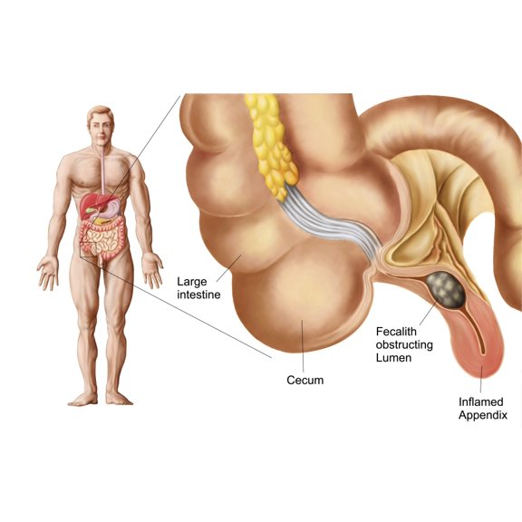 Medical ilustration of an appendix with appendicitis Canvas Art - Stocktrek Images (36 x 23)
