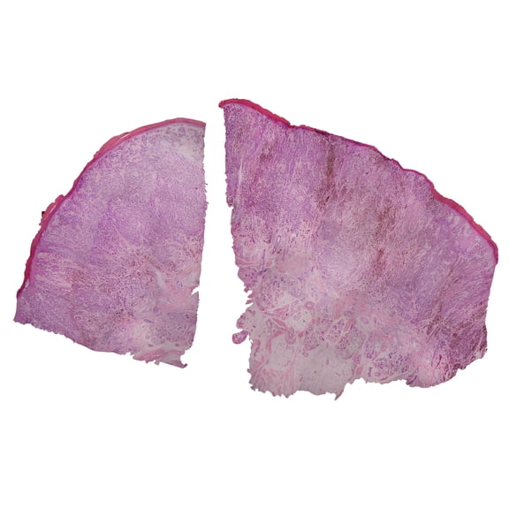 Melanoma (Human); Cross Section; H&E Stain by Go Science Crazy