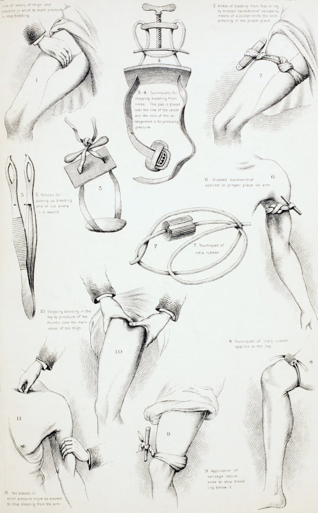Methods Of Arresting Bleeding From The Household Physician Published Circa 1890 Canvas Art - Ken Welsh Design Pics (22 x 36)