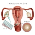 thumbnail image 1 of Methods of Female Birth Control Poster Print by Gwen Shockey/Science Source (24 x 18), 1 of 3