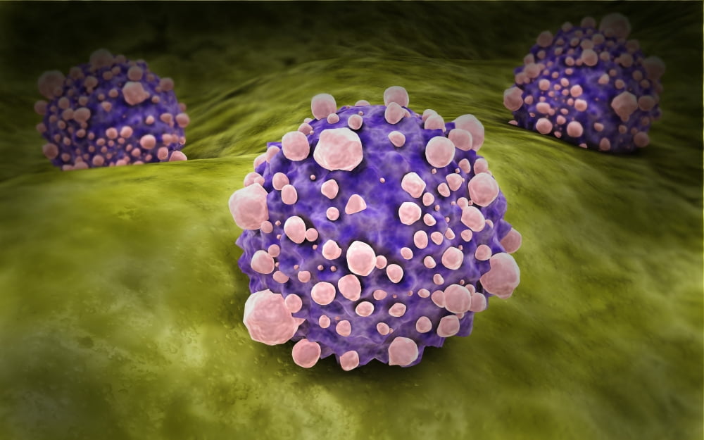 Microscipic view of pancreatic cancer cells Canvas Art - Stocktrek Images (18 x 12)