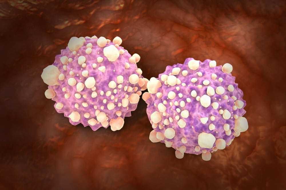 Microscipic view of pancreatic cancer cells Canvas Art - Stocktrek Images (35 x 24)