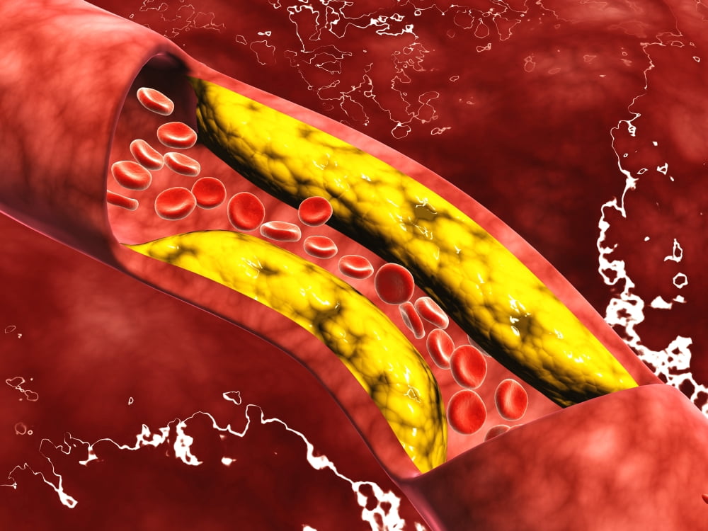 Microscopic view of fat plaque inside the artery Canvas Art - Stocktrek Images (17 x 13)