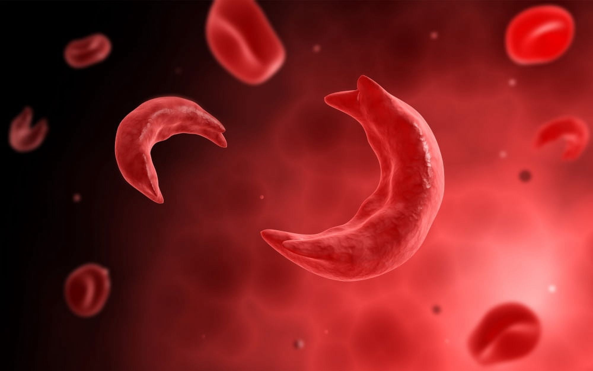 Microscopic view of sicke cells causing anemia disease Canvas Art - Stocktrek Images (18 x 12)
