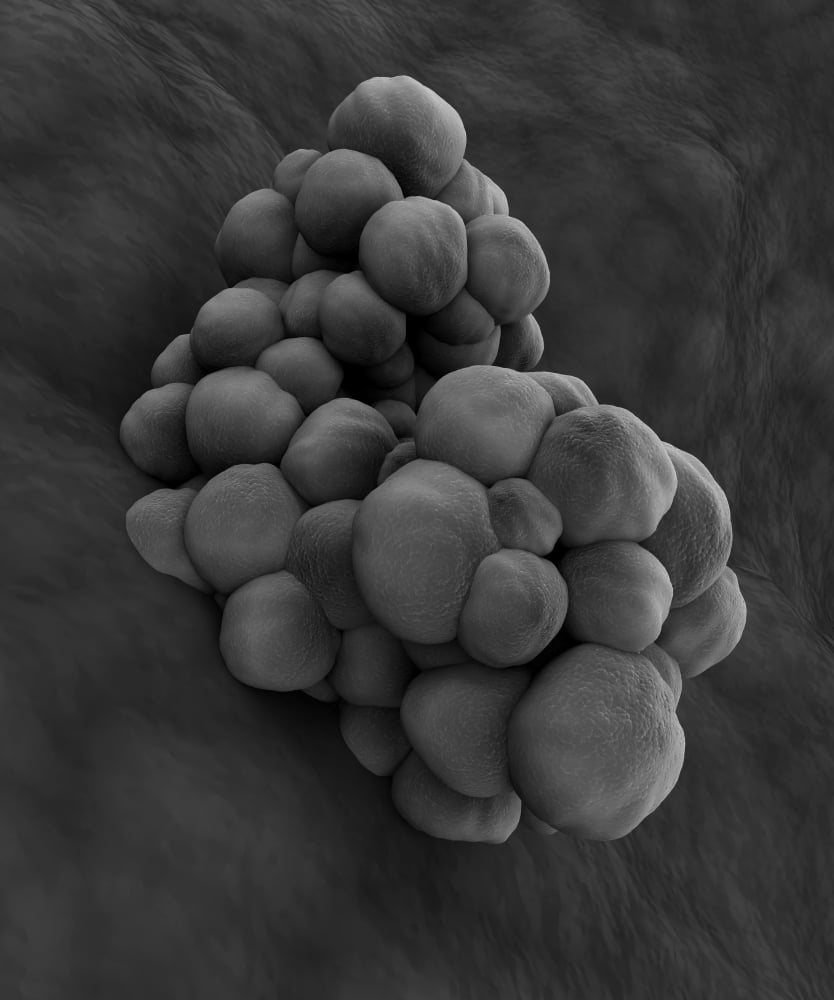 Microscopic view of tumor Canvas Art - Stocktrek Images (13 x 16)