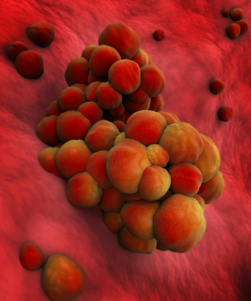 Microscopic view of tumor Canvas Art - Stocktrek Images (26 x 32)