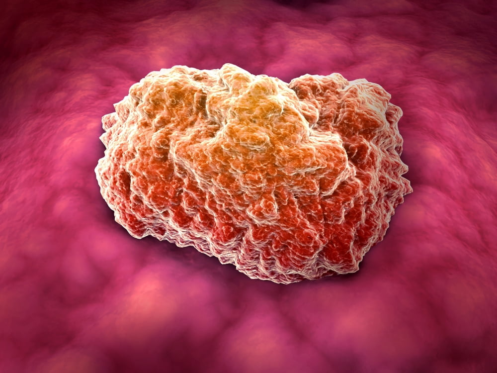 Microscopic view of tumor Canvas Art - Stocktrek Images (33 x 25)