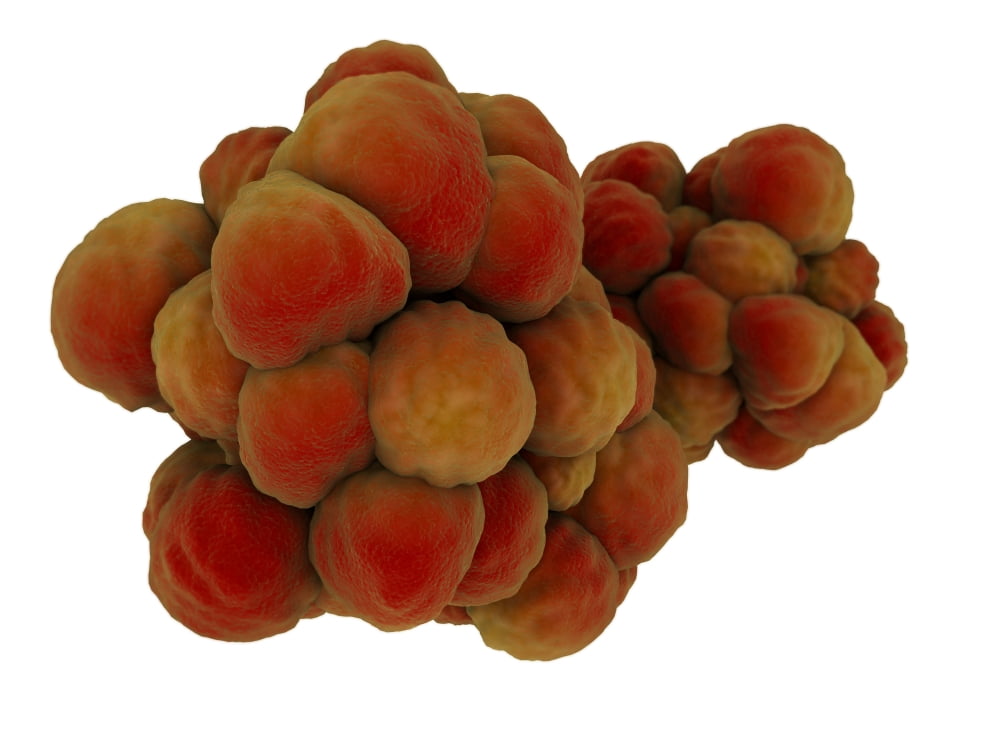 Microscopic view of tumor Canvas Art - Stocktrek Images (33 x 25)