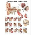 thumbnail image 1 of Middle Ear Conditions Anatomical Chart, 1 of 2
