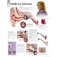 thumbnail image 1 of Middle Ear Infection chart : Wall Chart (Wallchart), 1 of 2