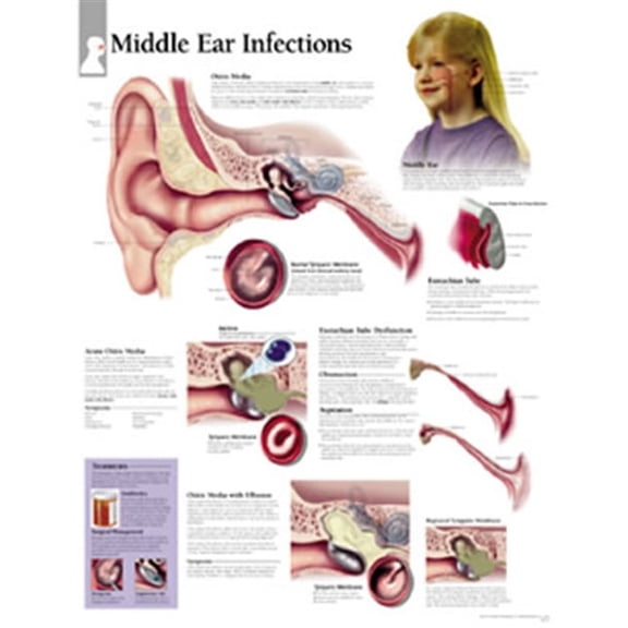 Middle Ear Infection chart : Wall Chart (Wallchart)