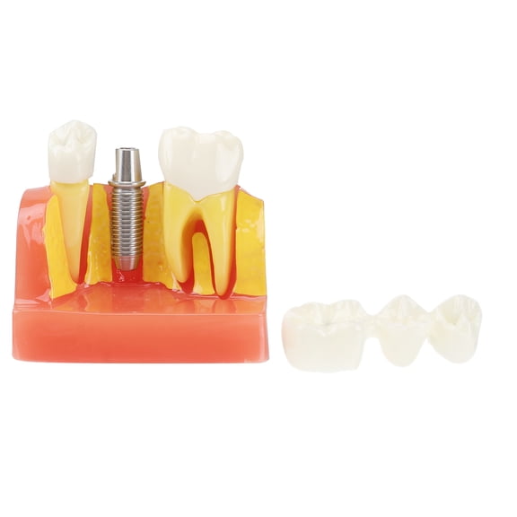 Milisten for Tooth Implant Dental Teeth Model Oral Education Demonstration