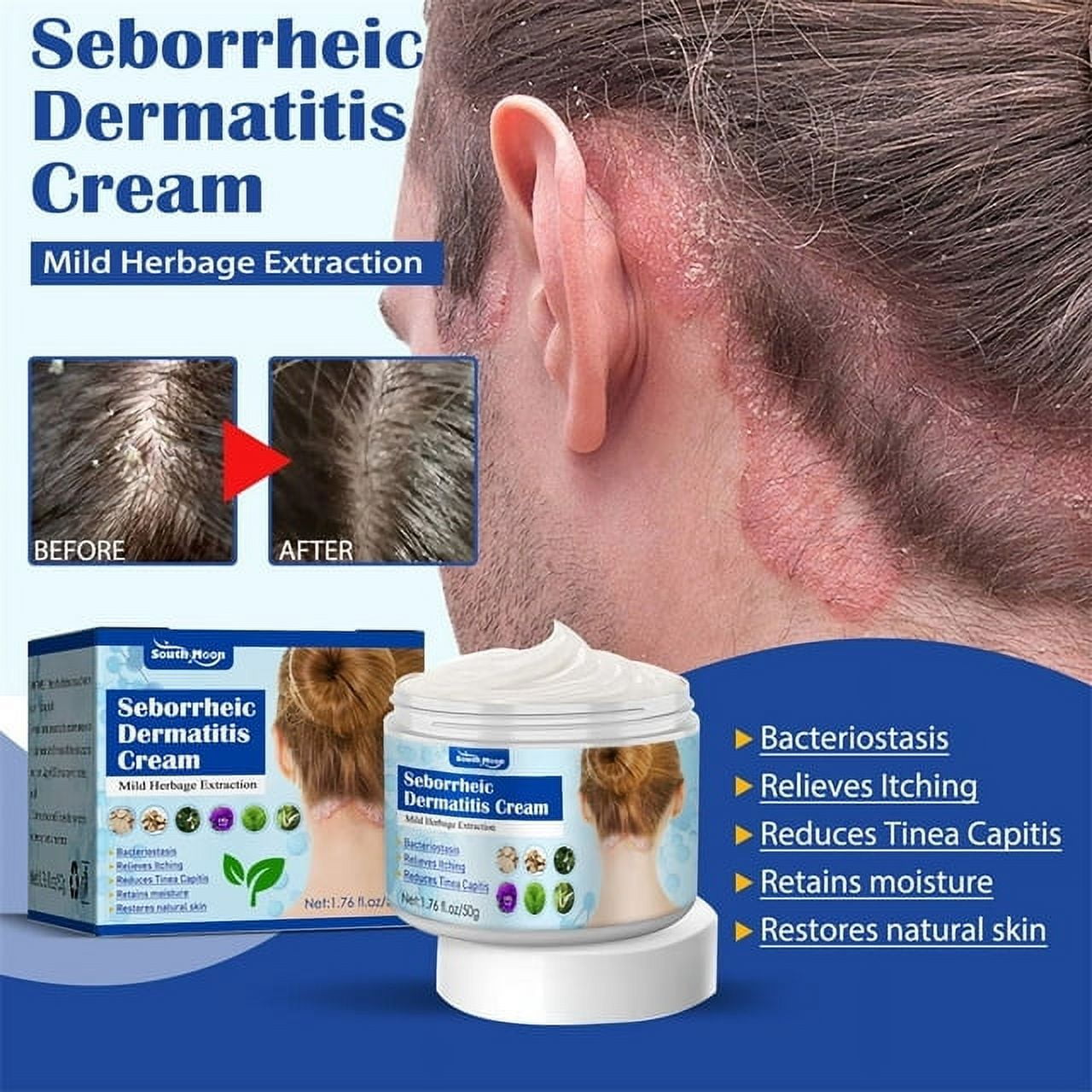 Molvadio LLC 3 Pack Seborrheic Dermatitis Cream, Psoriasis Anti-itch ...