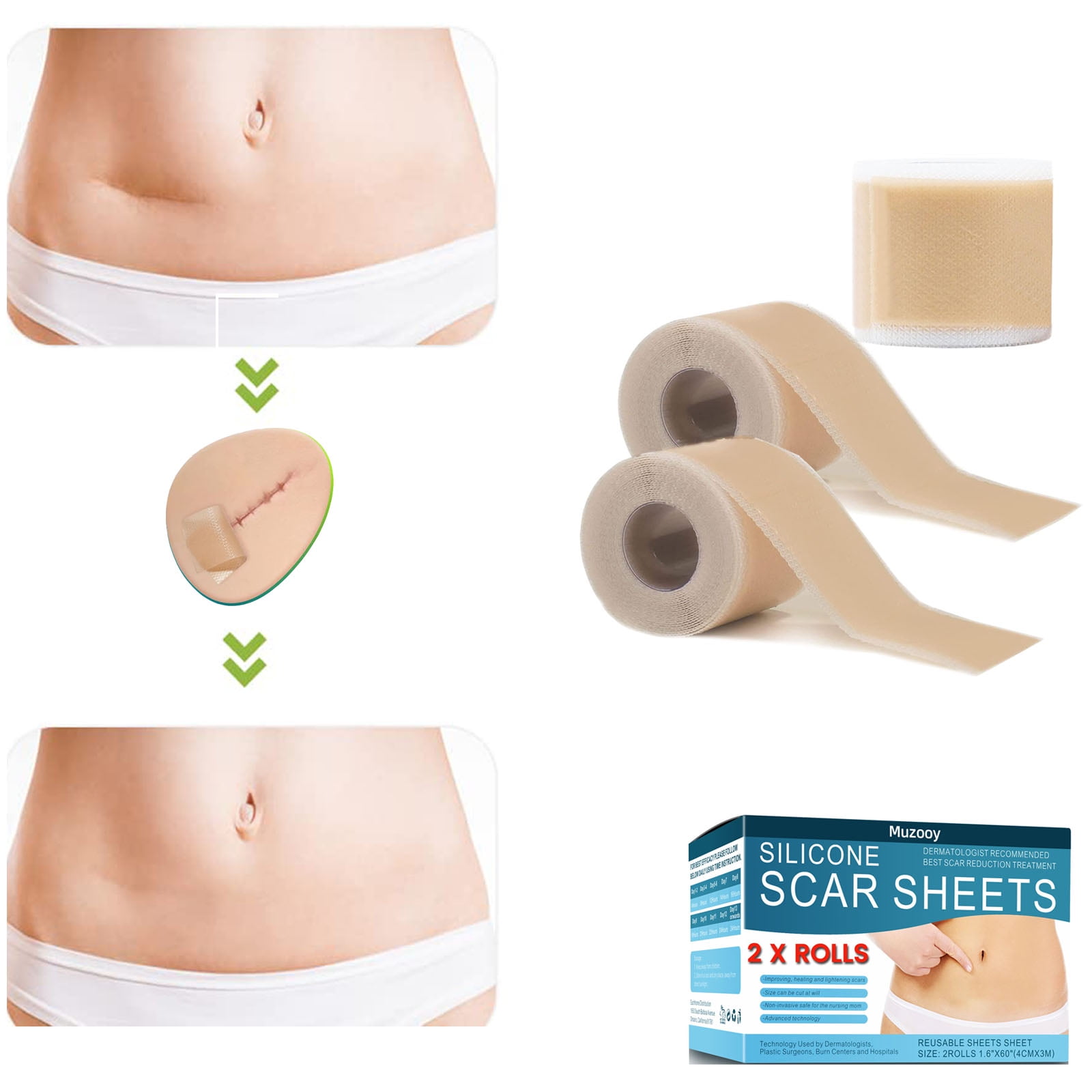 Auxbales Silicone Scar Sheets (1.6” x 120”Roll-3M), Silicone Scar Tape  Roll, Scar Silicone Strips, Scar Removal Sticker for C-Section, Surgery,  Burn, Keloid, Acne 