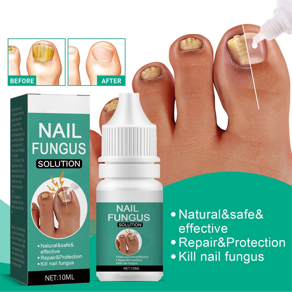 Nail Care Essence Toenail Thickening Yellow Ingrown Onychomycosis Nail