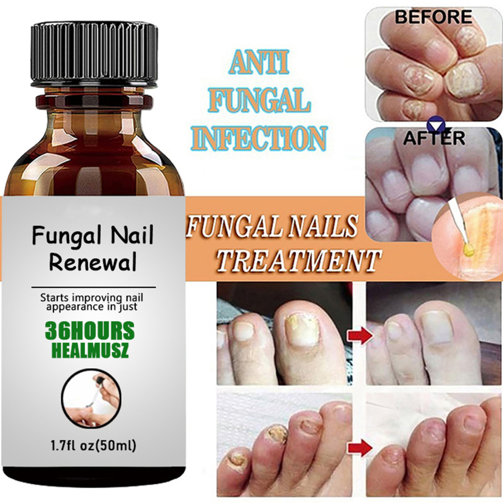 Nail Ingrown Repair Solution AntiInfection Onychomycosis Paronychia