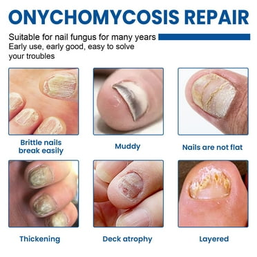 Nail Repair Patch Grey Fungal Nails Thickening Soft Paronychia Treatment Anti Infection Correction Stickers Toenail 120pcs