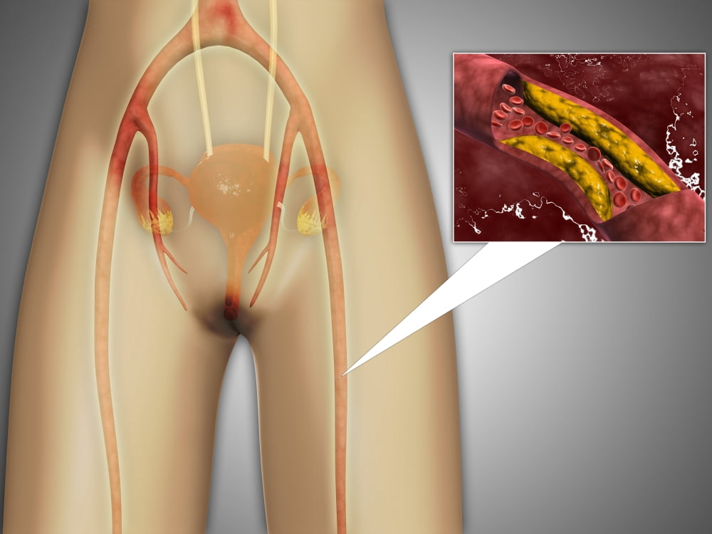 Narrowed artery near leg with microscopic close-up Canvas Art - Stocktrek Images (17 x 13)