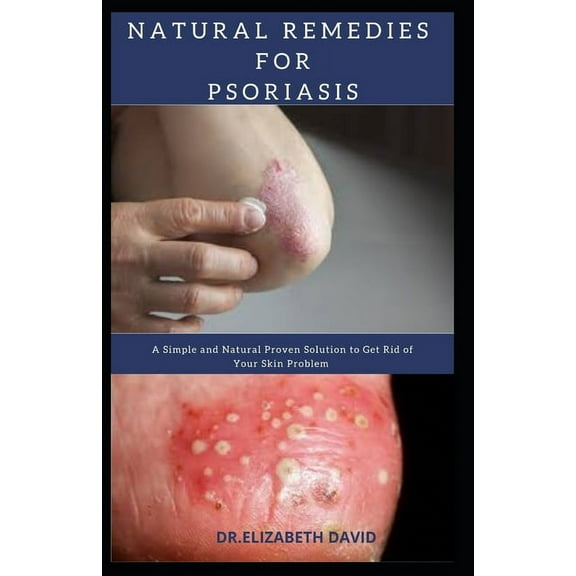Natural Remedies for Psoriasis: A Simple and Natural Proven Solution to Get Rid of Your Skin Problem (Paperback) by Dr. Elizabeth David