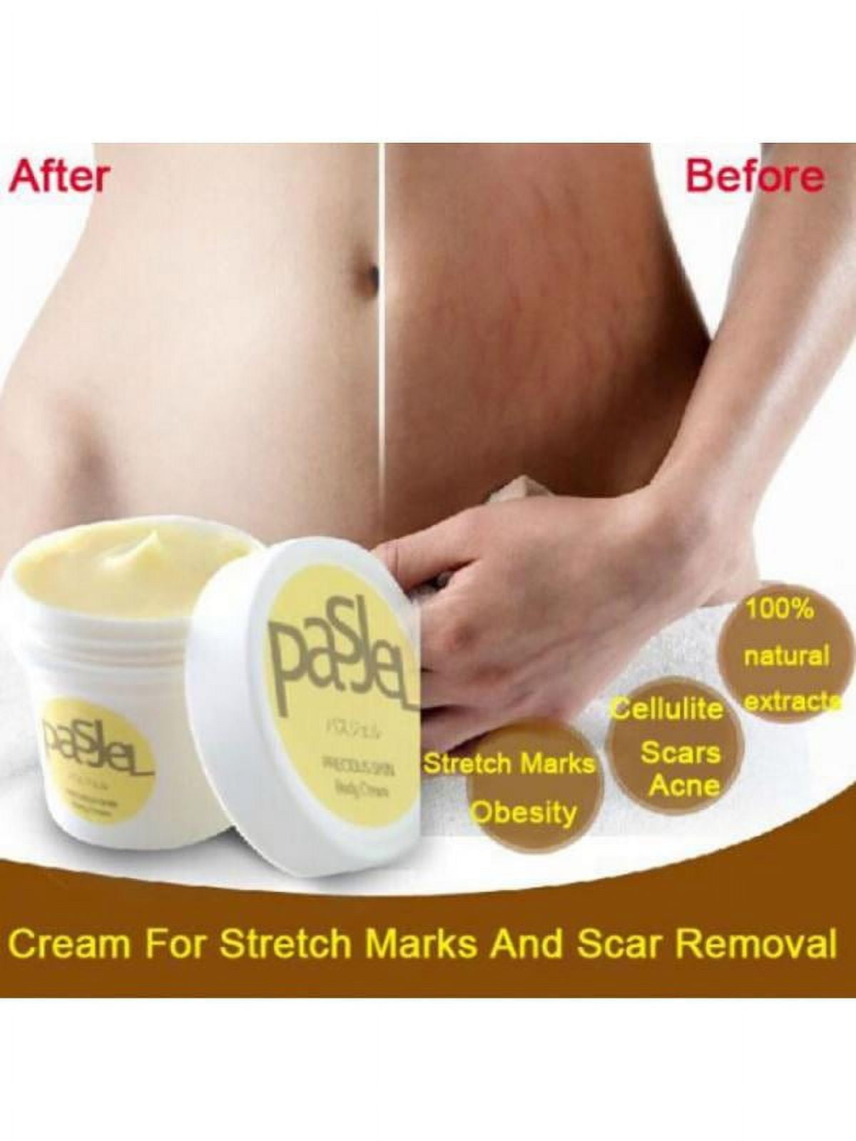 New Pattern Removal Stretch Marks Cream Fat Scar Striae Gravidarum Treatment 50g