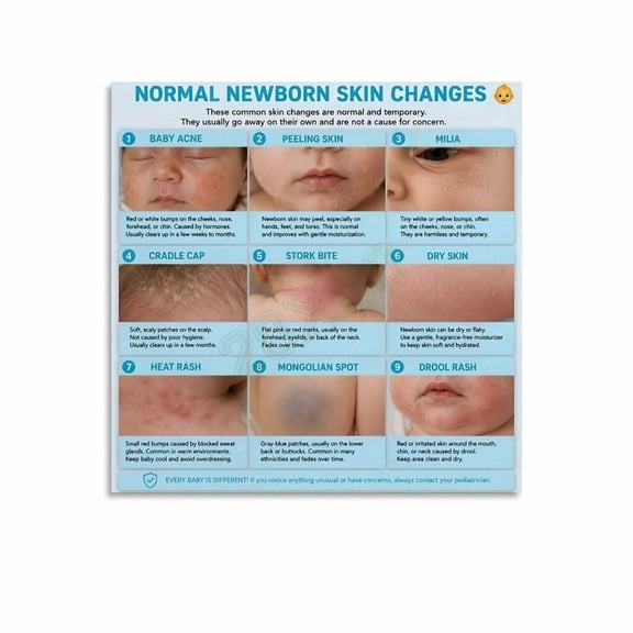 Normal Newborn Skin Changes Poster Baby Acne Cradle Cap Milia Guide Canvas for Living Room Bedroom Decor