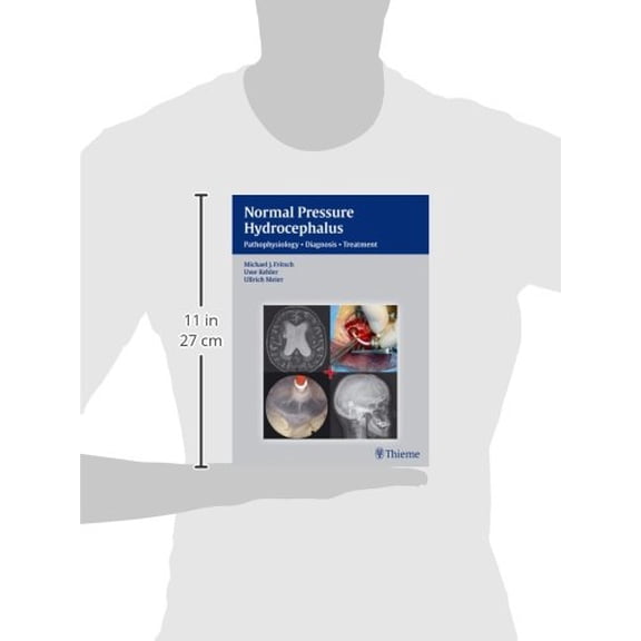 Pre-Owned Normal Pressure Hydrocephalus: Pathophysiology - Diagnosis - Treatment (Hardcover) 3131646012 9783131646019