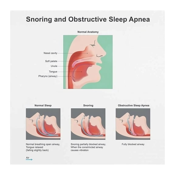 Obstructive Sleep Apnea Reference Poster Educational Chart for Sleep Center Clinic Office Decor Medical Education Resource