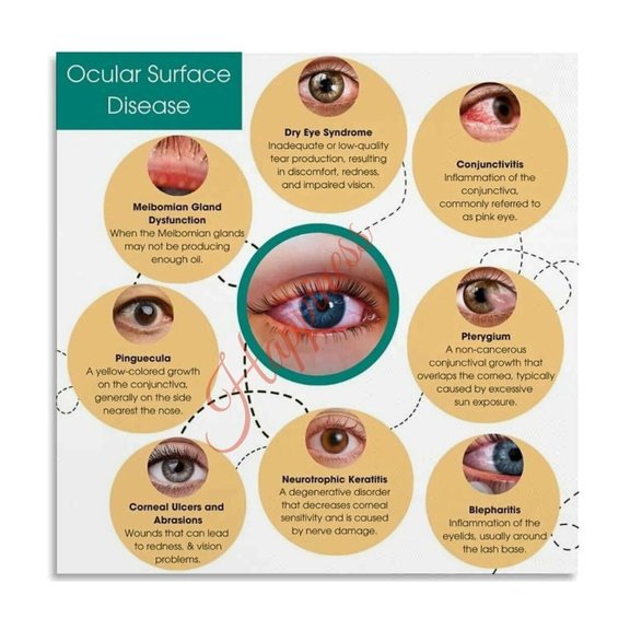 Ocular Surface Disease Symptom Chart Poster Ophthalmology Clinic Decor Canvas for Living Room Bedroom Decor