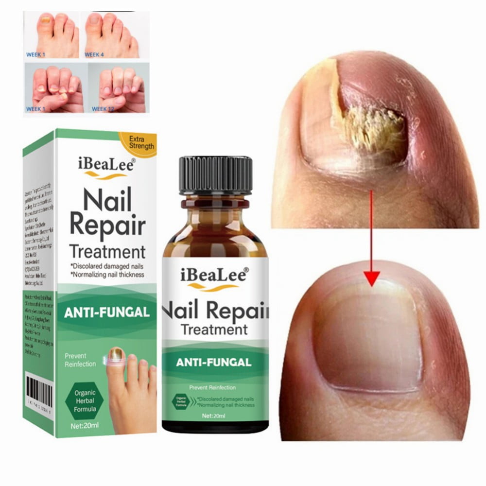 Onychomycosis Repair Solution, Concave And Convex Soft Nail Thickening