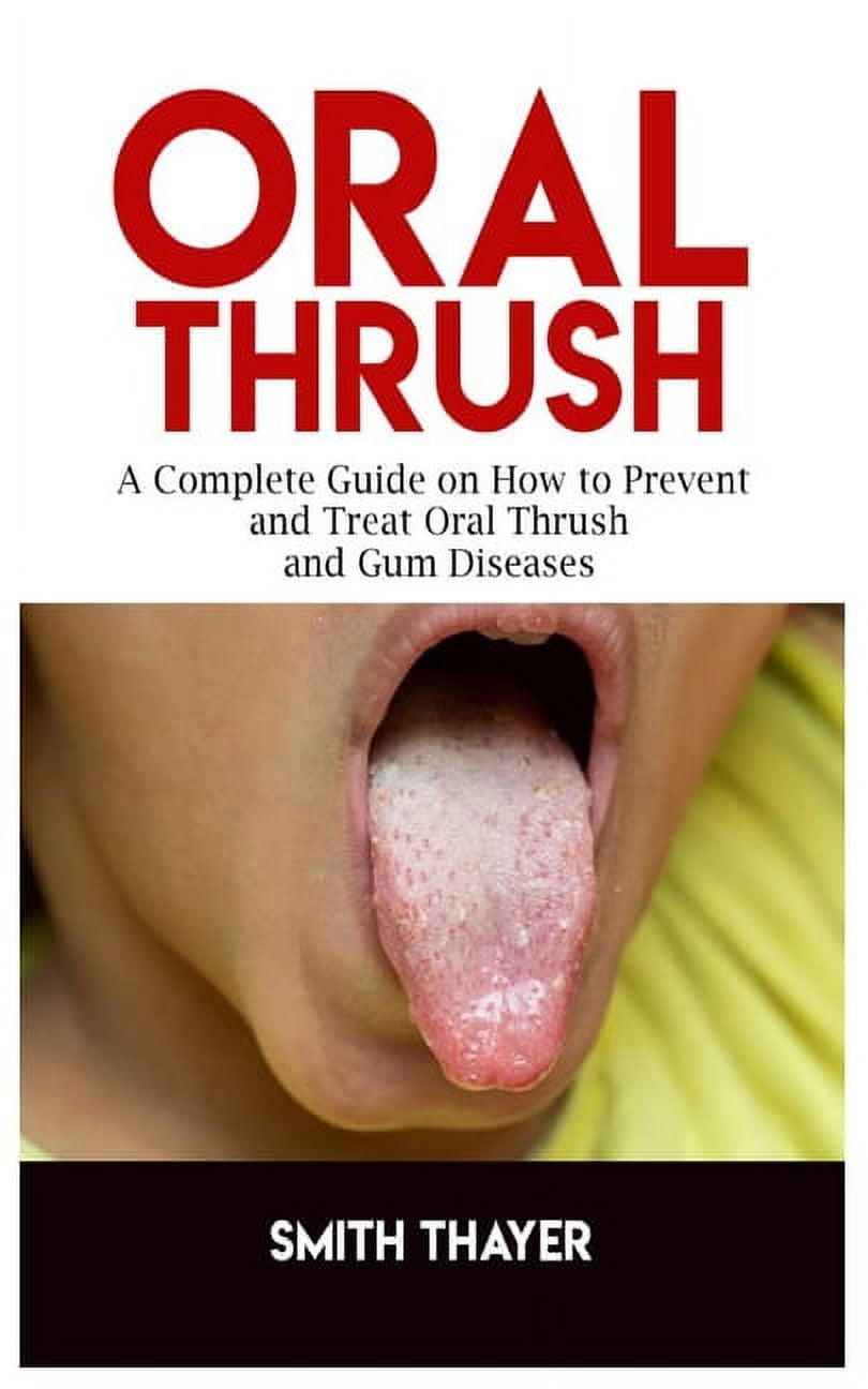 Oral thrush cure deals