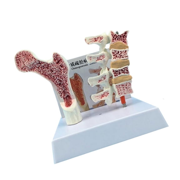 Osteoporosis Spine Model Medicals Learning Tool Human Anatomy Osteoporosis Model