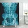 thumbnail image 1 of PKNMT Adult X Ray Lumbar Spine Show Mild Scoliosis Aged Anatomy Back Bend Black Body Bone Bathroom Shower Curtain 66x72 inch, 1 of 1