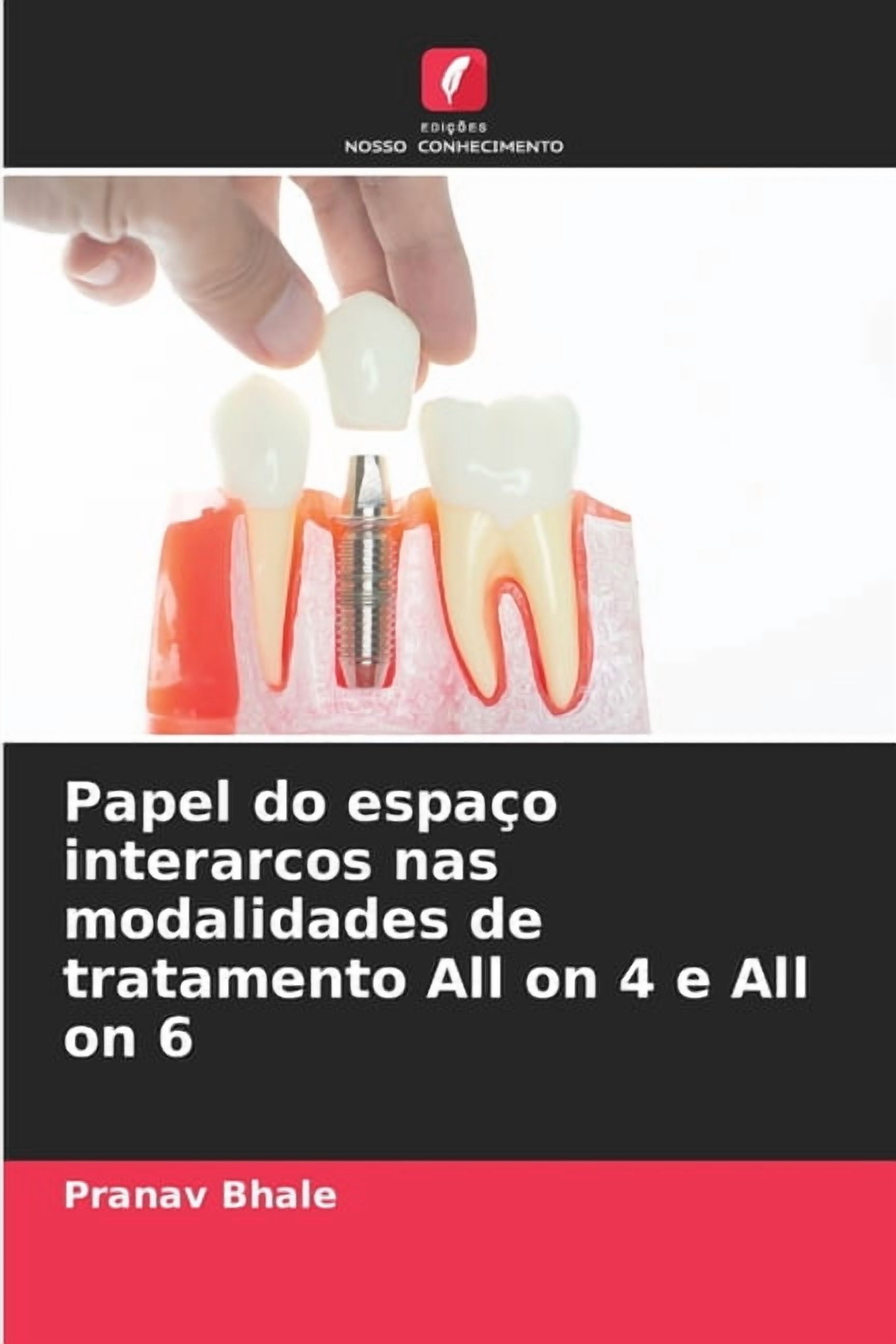Papel do espaÃ§o interarcos nas modalidades de tratamento All on 4 e All on 6, (Paperback)
