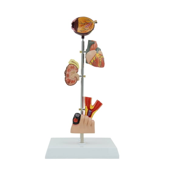 Anatomical Pathological Kidney Model for Diseases Study Lecture, Diabetes Pathology Anatomy Model