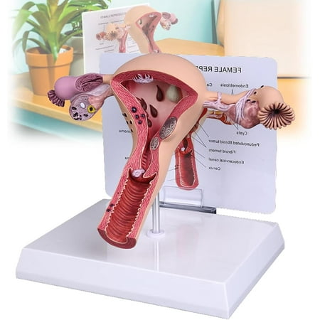 Pathological Uterus Ovary Model, Human Anatomical Model Female Reproductive Organ Model for School Teaching Demonstration Tool