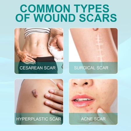 Pecoda Scar Removal Medical Grade Spray, Pregnant Women Stretch Mark Reduction Spray, Skincare Scar Spray for Scars from Injuries, Surgeries, Burns, Stretch Marks(1 PC)