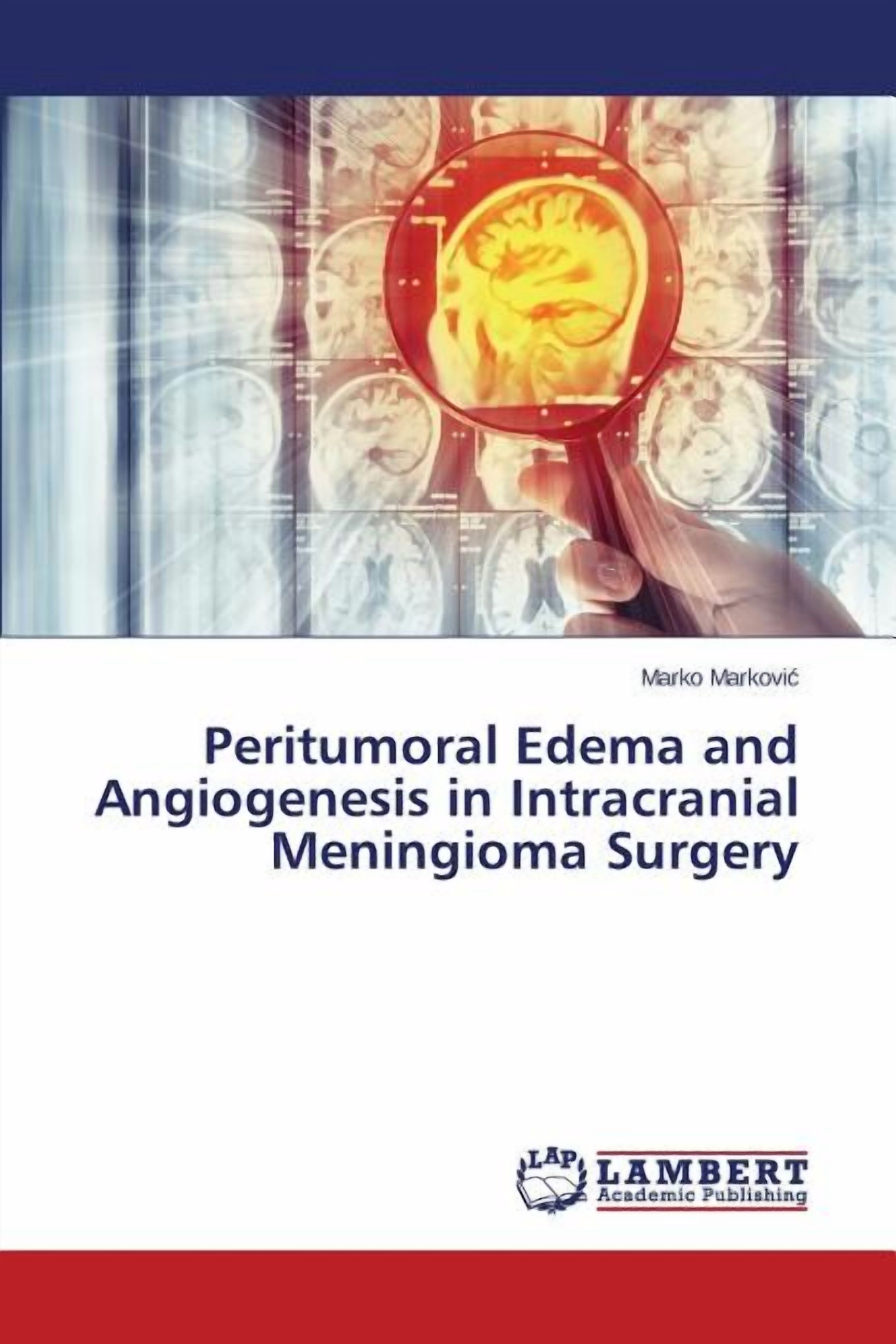Peritumoral Edema and Angiogenesis in Intracranial Meningioma Surgery ...