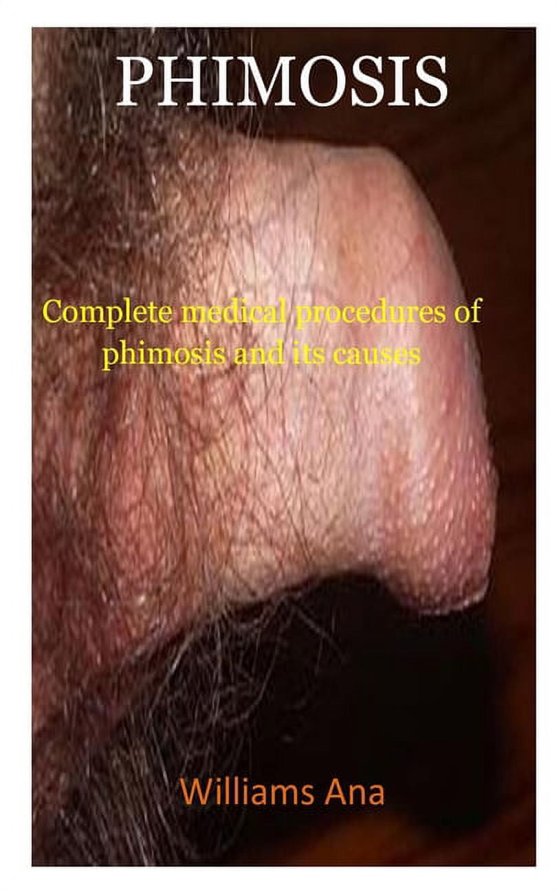 Phimosis : A complete medical procedure of phimosis and its causes  (Paperback)