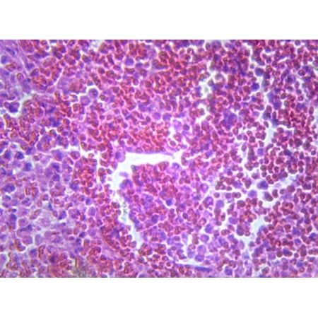 Pneumonia (Human Respiratory System); Section; H&E Stain by Go Science Crazy