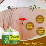 Poseca 50g Pregnancy Stretch Mark Repair Cream Maternity Obesity Skin Postpartum Stretch Scar Body Marks Remover Smooth Skin Care