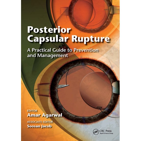 Posterior Capsular Rupture: A Practical Guide to Prevention and Management, (Paperback)