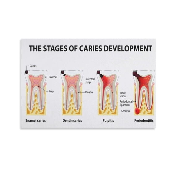 Posters on The Stages of Tooth Decay Development, Dental Care, Dental Aesthetics, And Art Poster Decorative Painting Canvas Wall Art Living Room Posters Bedroom Painting