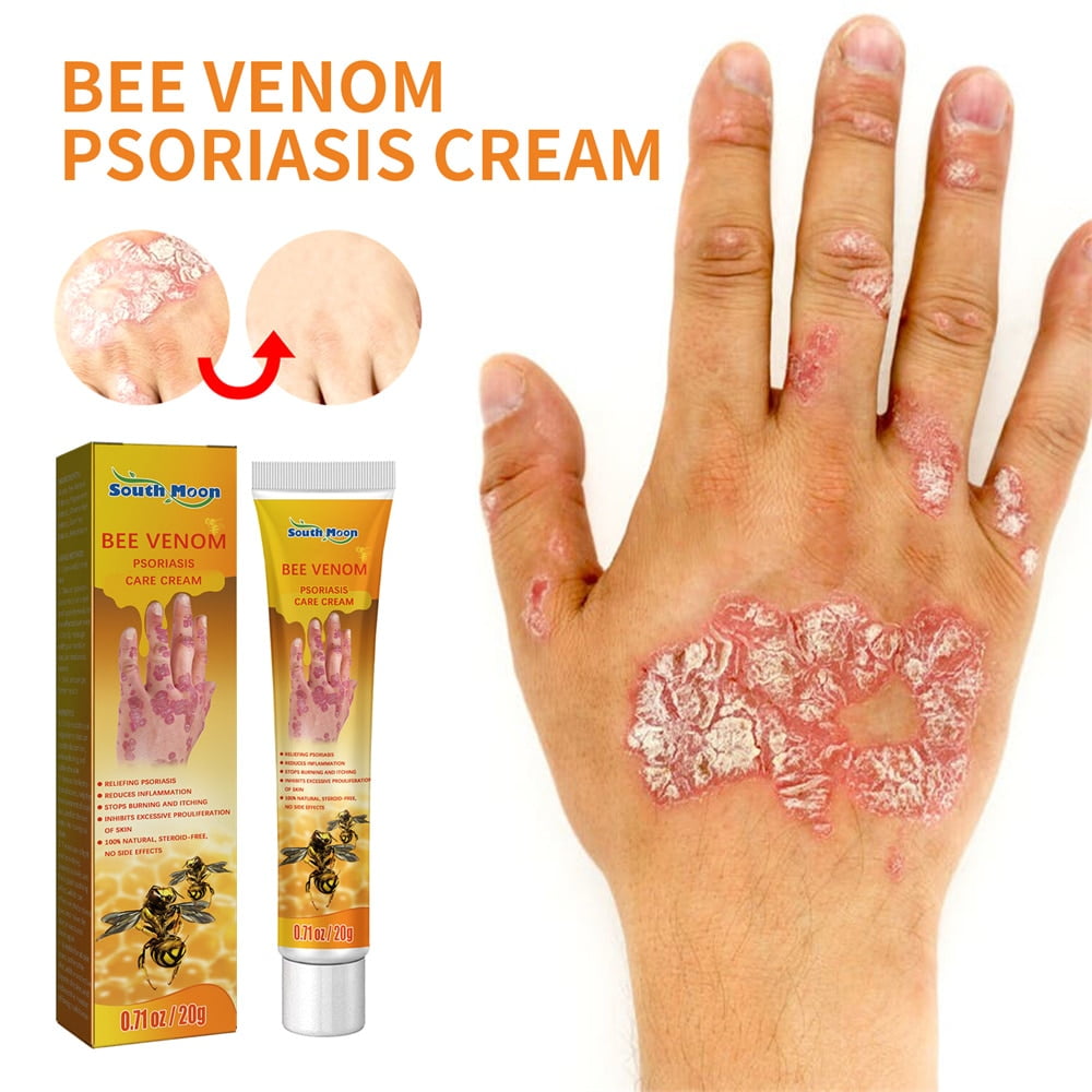 Psoriasis Cream Removal Psoriasis Eczema Best Against Psoriasis Dermatitis Products Natural