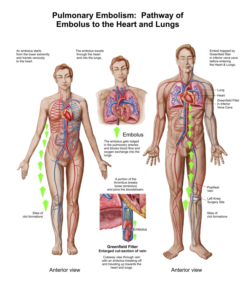 Pulmonary embolism pathway of embolus to the heart and lungs Canvas Art - Stocktrek Images (13 x 16)