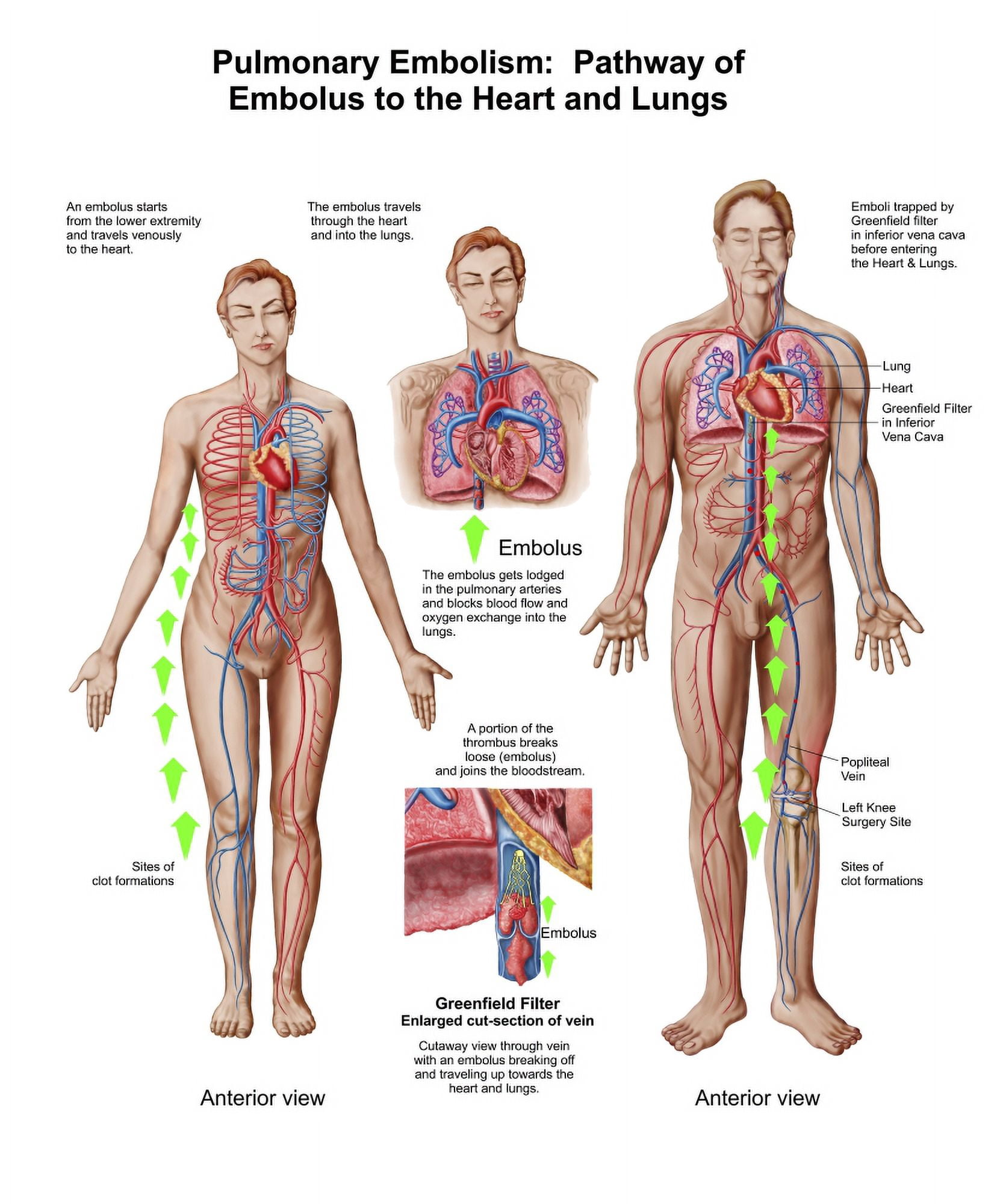 Pulmonary embolism pathway of embolus to the heart and lungs Canvas Art - Stocktrek Images (26 x 31)