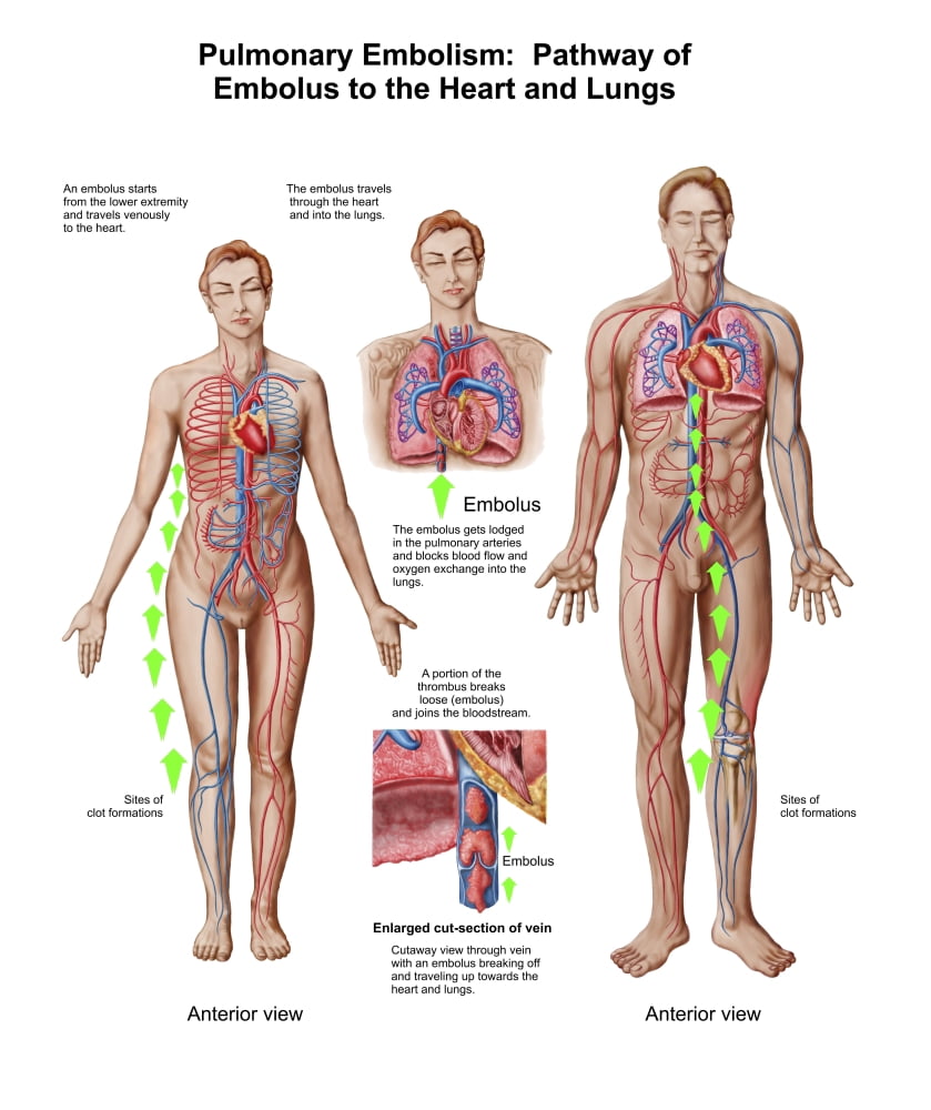 Pulmonary embolism pathway of embolus to the heart and lungs Canvas Art - Stocktrek Images (26 x 31)