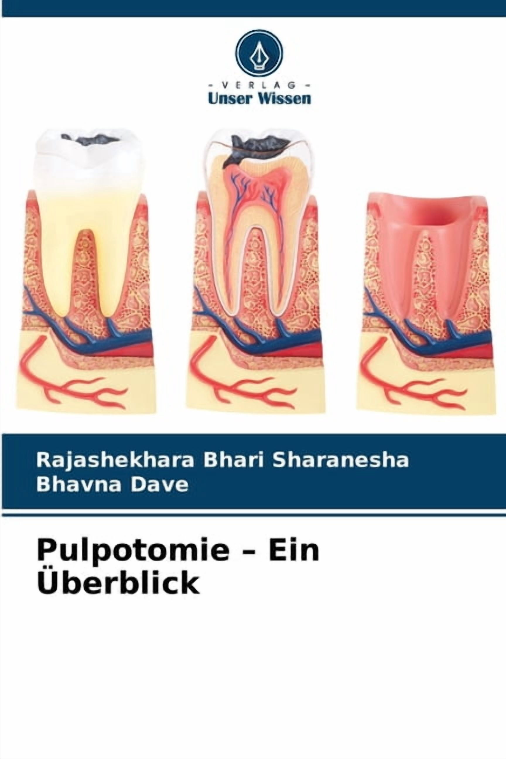 Pulpotomie - Ein Ãberblick, (Paperback)